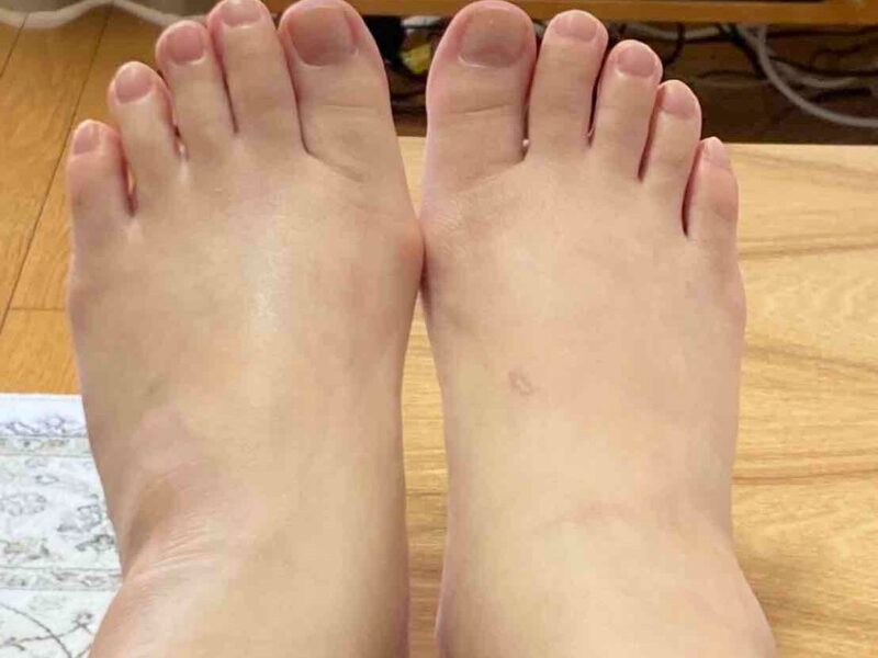 出産予定日近くの様子①足が象のようにむくんだ状態の写真