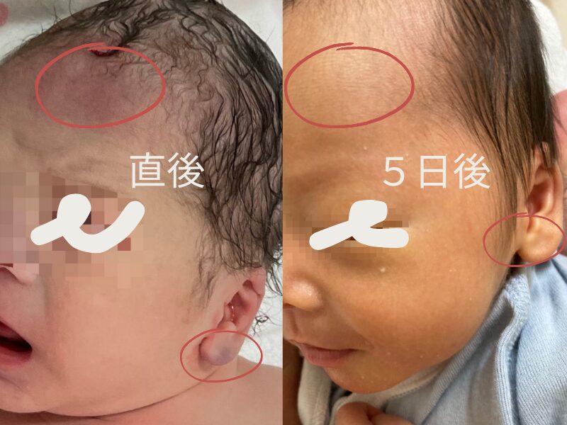 鉗子分娩後の赤み・傷跡の経過写真(直後と５日後)