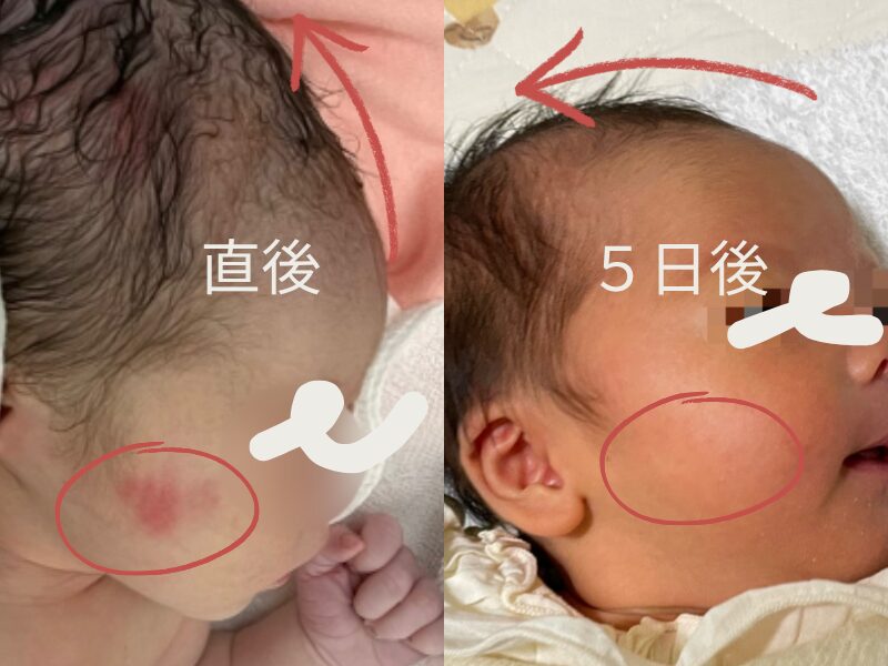 鉗子分娩後の頭の形と赤みの経過写真(直後と５日後)