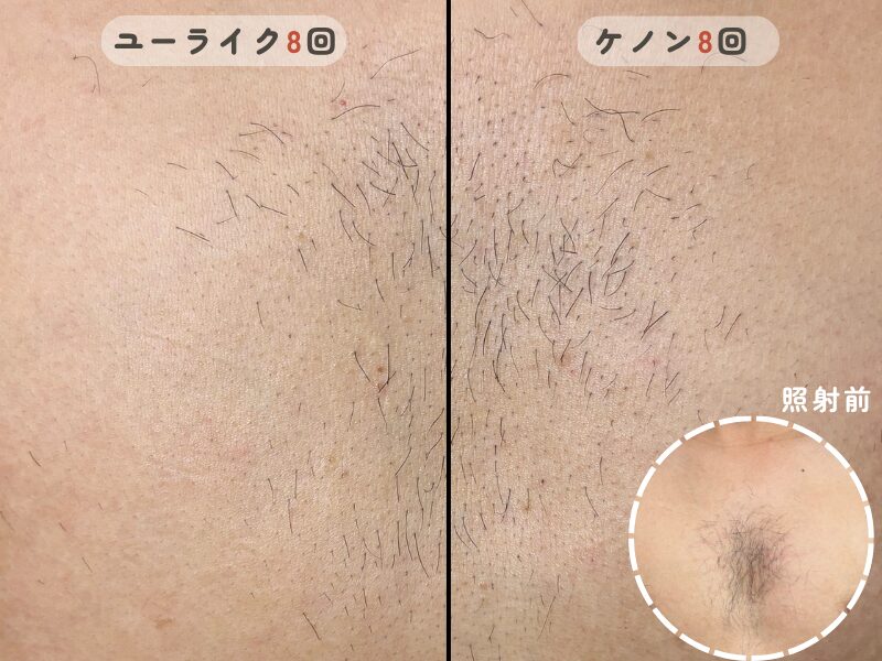 Ulike Air Pro Sとケノンで効果の差を実験した比較写真