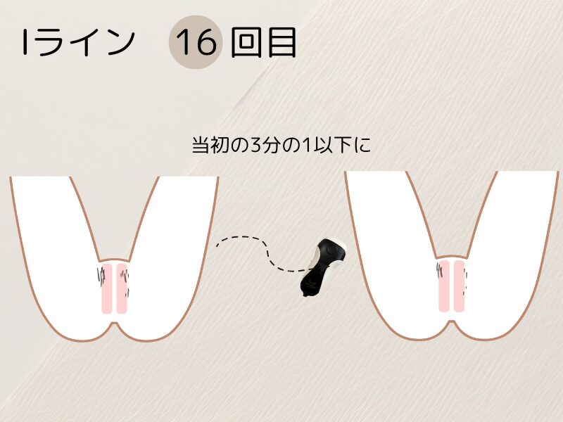 ケノンでIラインを16回脱毛した変化を表したイラスト