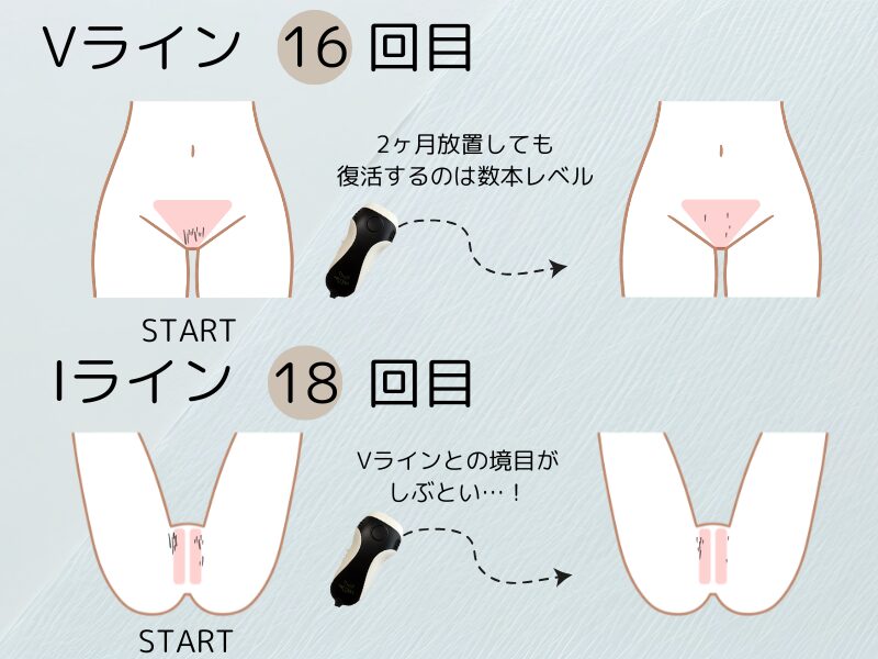 Vラインの変化とIラインの変化のイメージイラスト