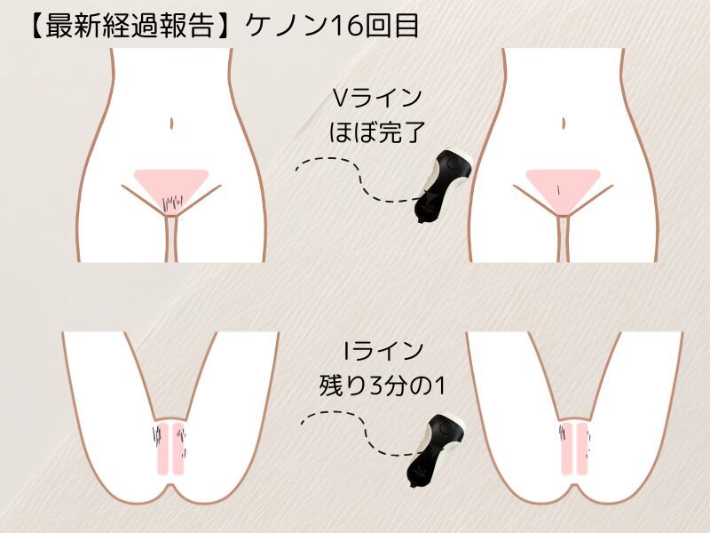 ケノンでVIO脱毛した毛の量をイラストで表現した画像