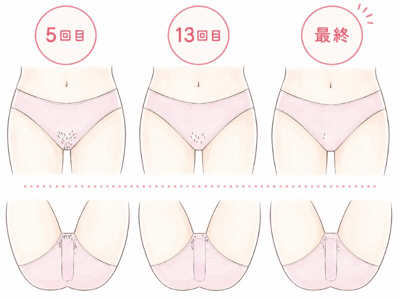 18回当てて最終的なVライン・Iラインの残存するムダ毛のイメージ図