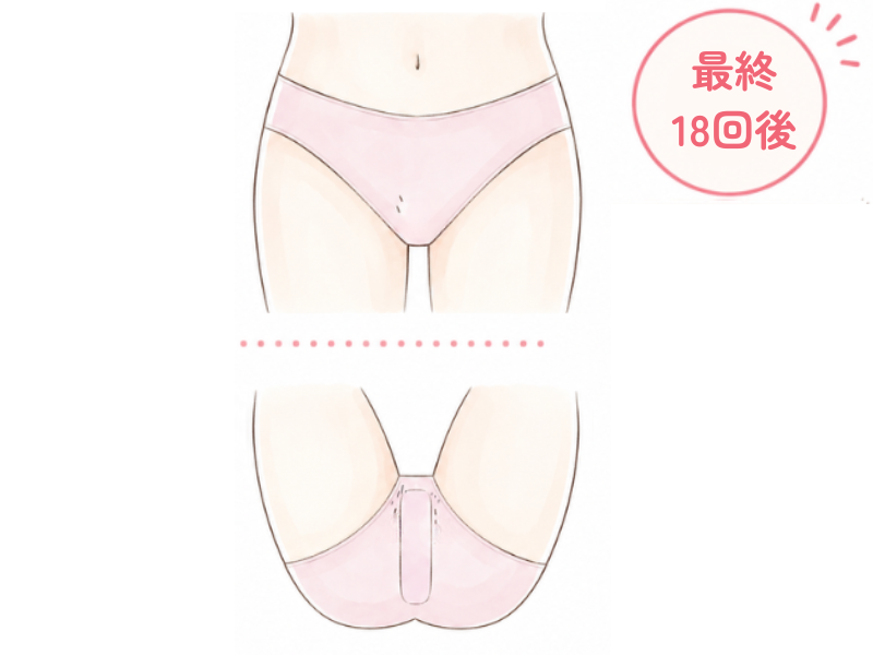 18回当てて最終的なVライン・Iラインの残存するムダ毛のイメージ図