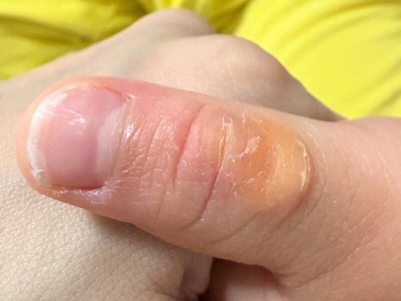指しゃぶりによる吸いだこの写真