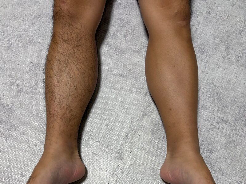 脱毛前にすね毛を剃毛した状態