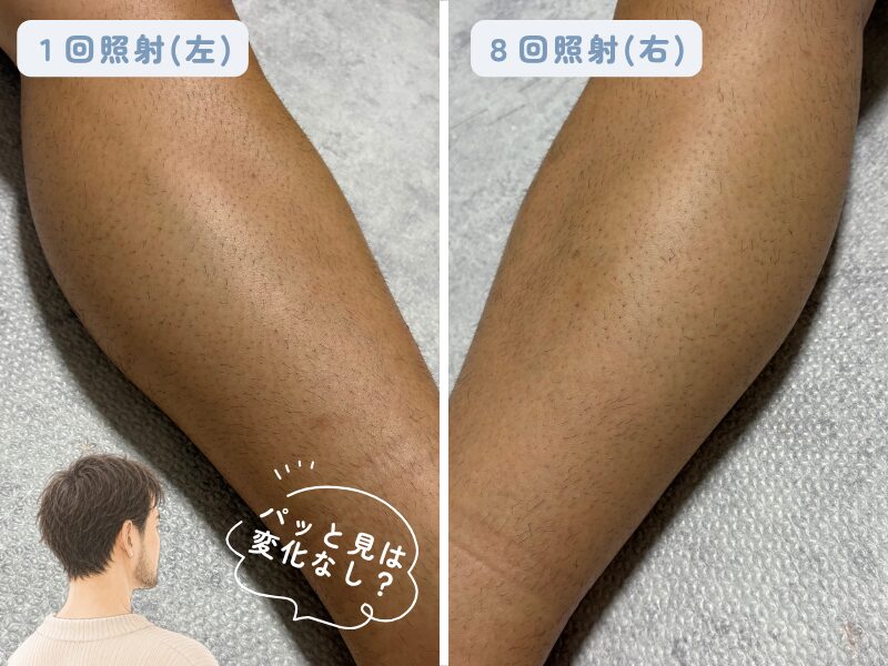 すね毛脱毛後の左右の脚の比較写真