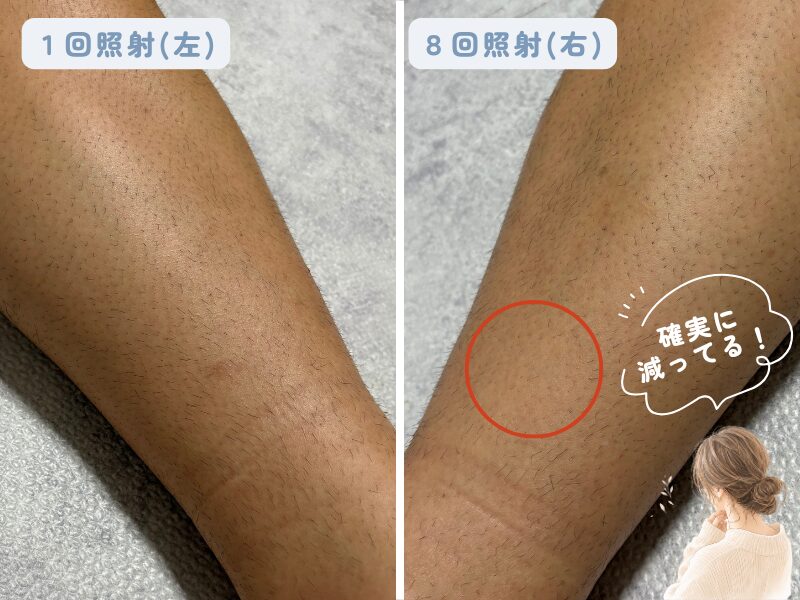 ８回照射した脚の一部が脱毛効果が表れている様子