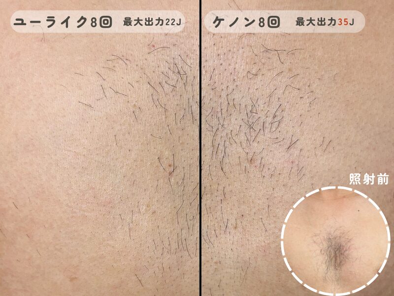 Ulike Air Pro Sとケノンで効果の差を実験した比較写真