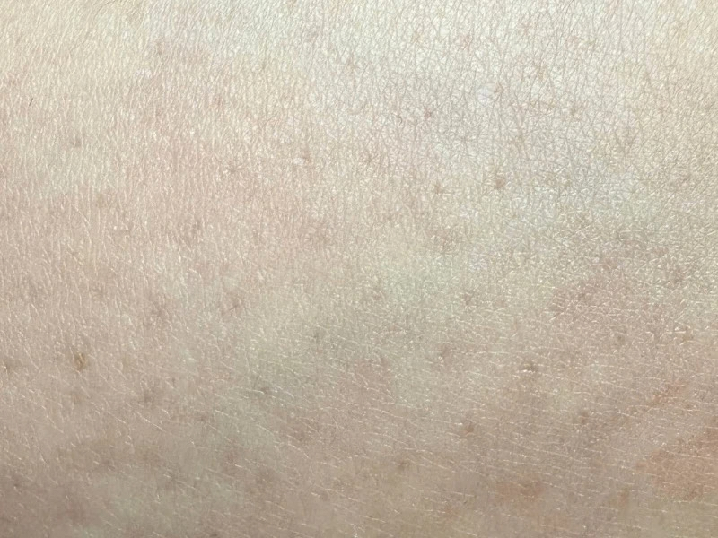 私のすねのアップ写真　毛穴がポツポツと目立つ状態