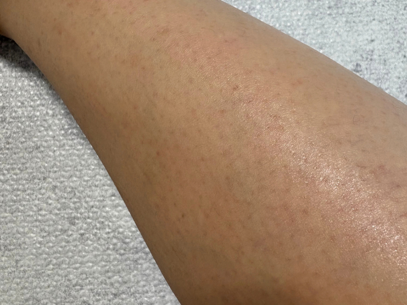 私のすねのアップ写真　毛穴がポツポツと目立つ状態